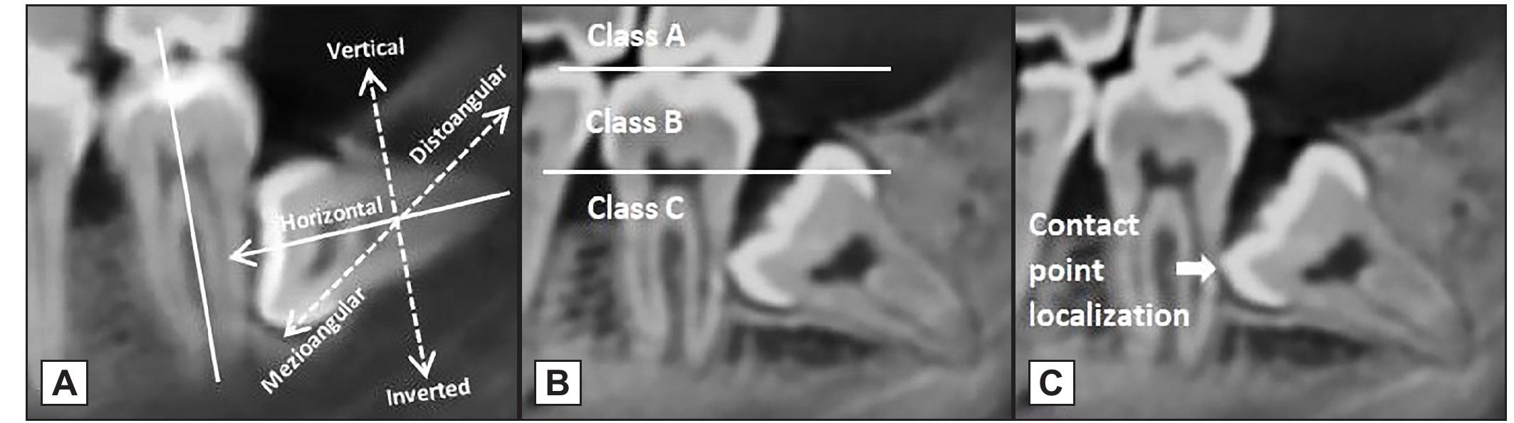(PDF) Can the Position of the Impacted Third Molars Be an Early Risk ...