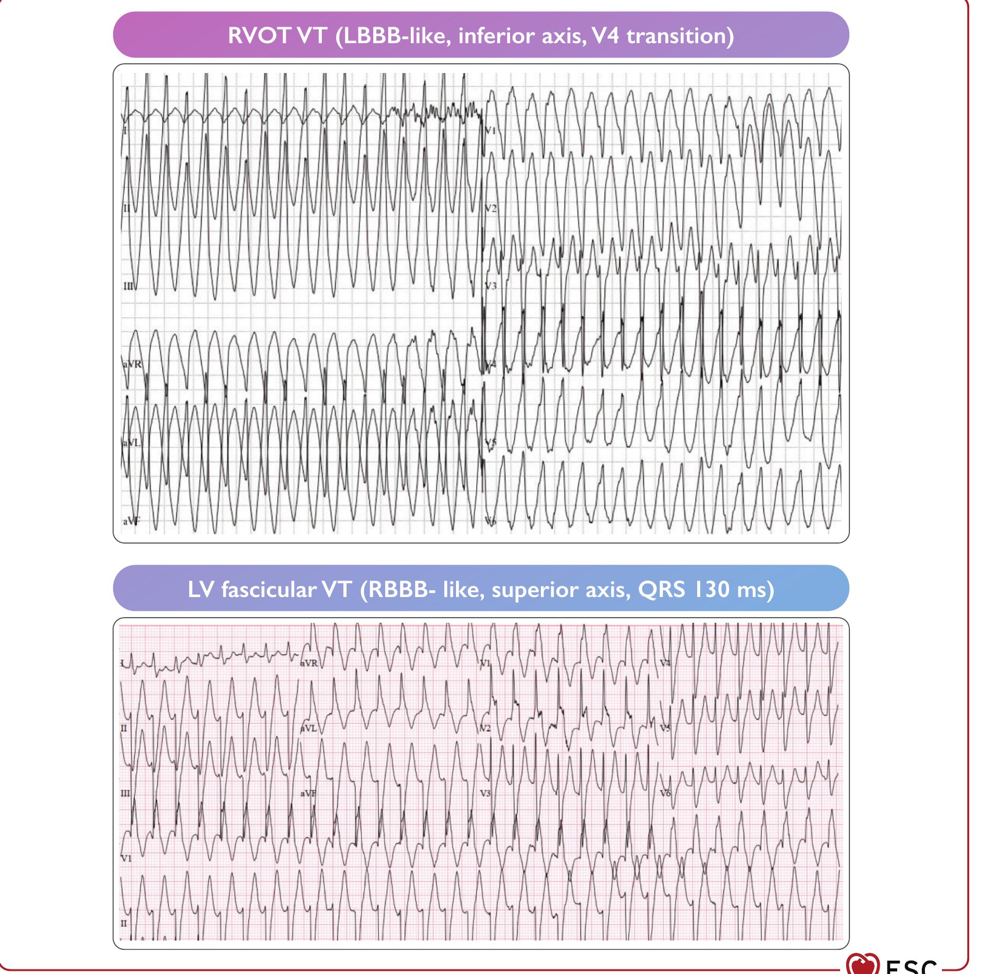 Typical idiopathic ventricular tachycardia morphologies.
