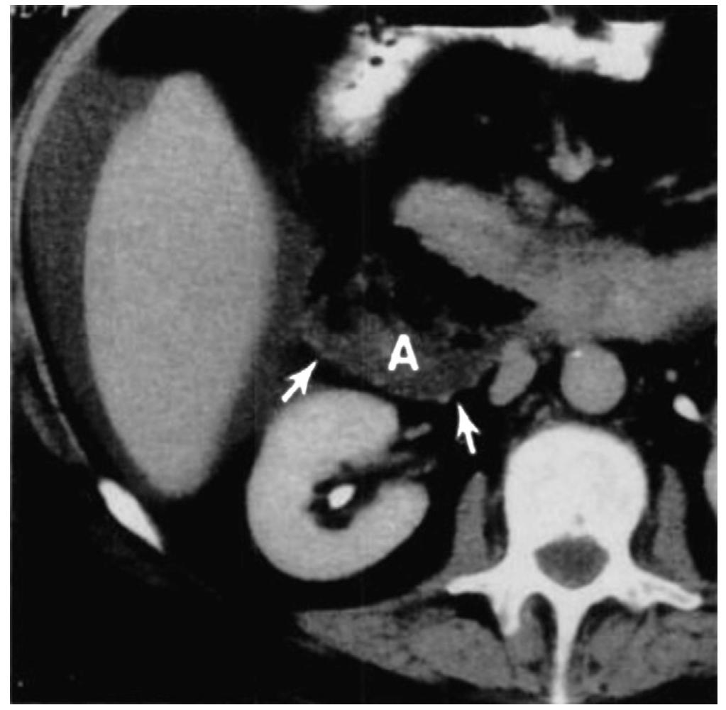 Fic. 4. abscess in the right anterior pararenal space (a).
