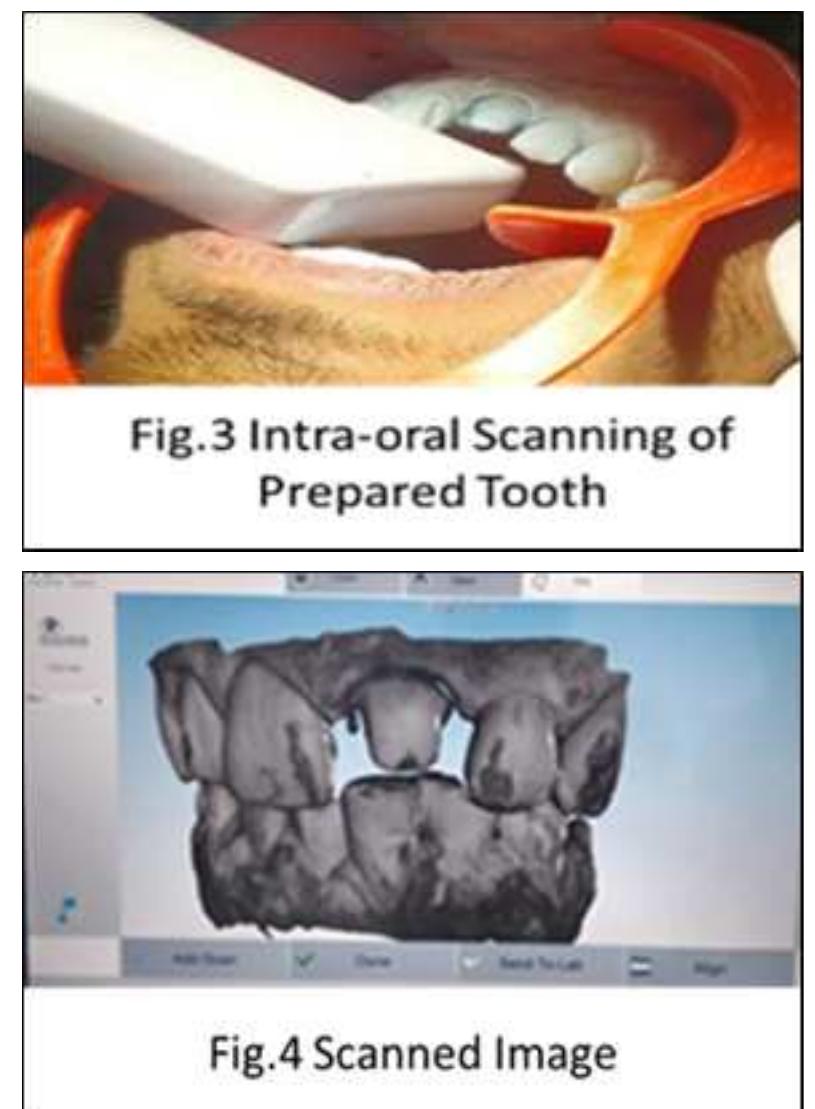 (PDF) Intraoral Scanner: A New Era of Digital Dentistry