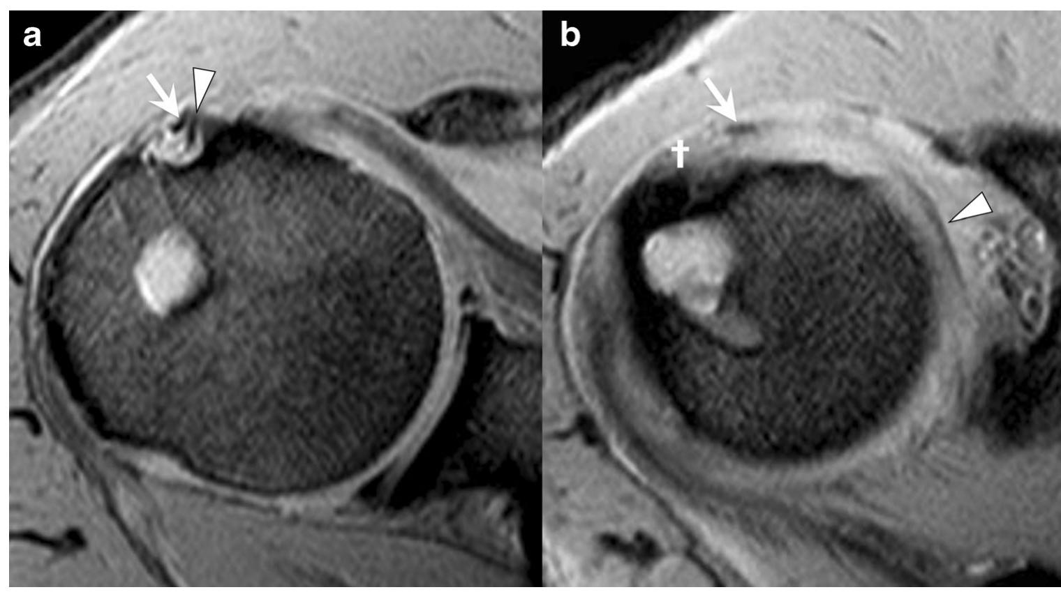 (PDF) Aponeurotic expansion of the supraspinatus tendon