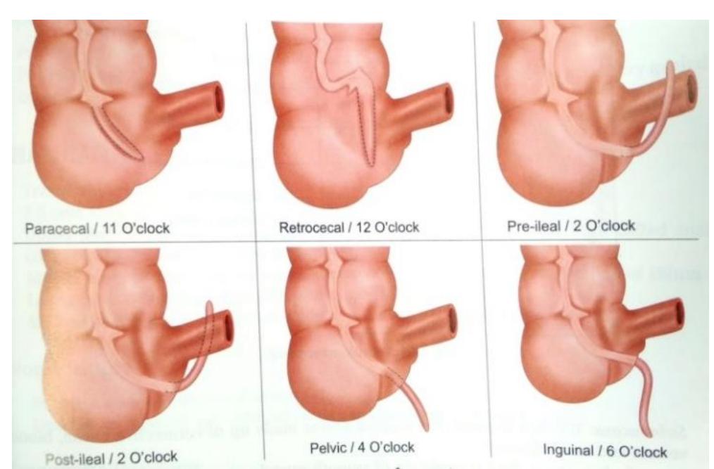Perfed Appendix Various positions of appendix