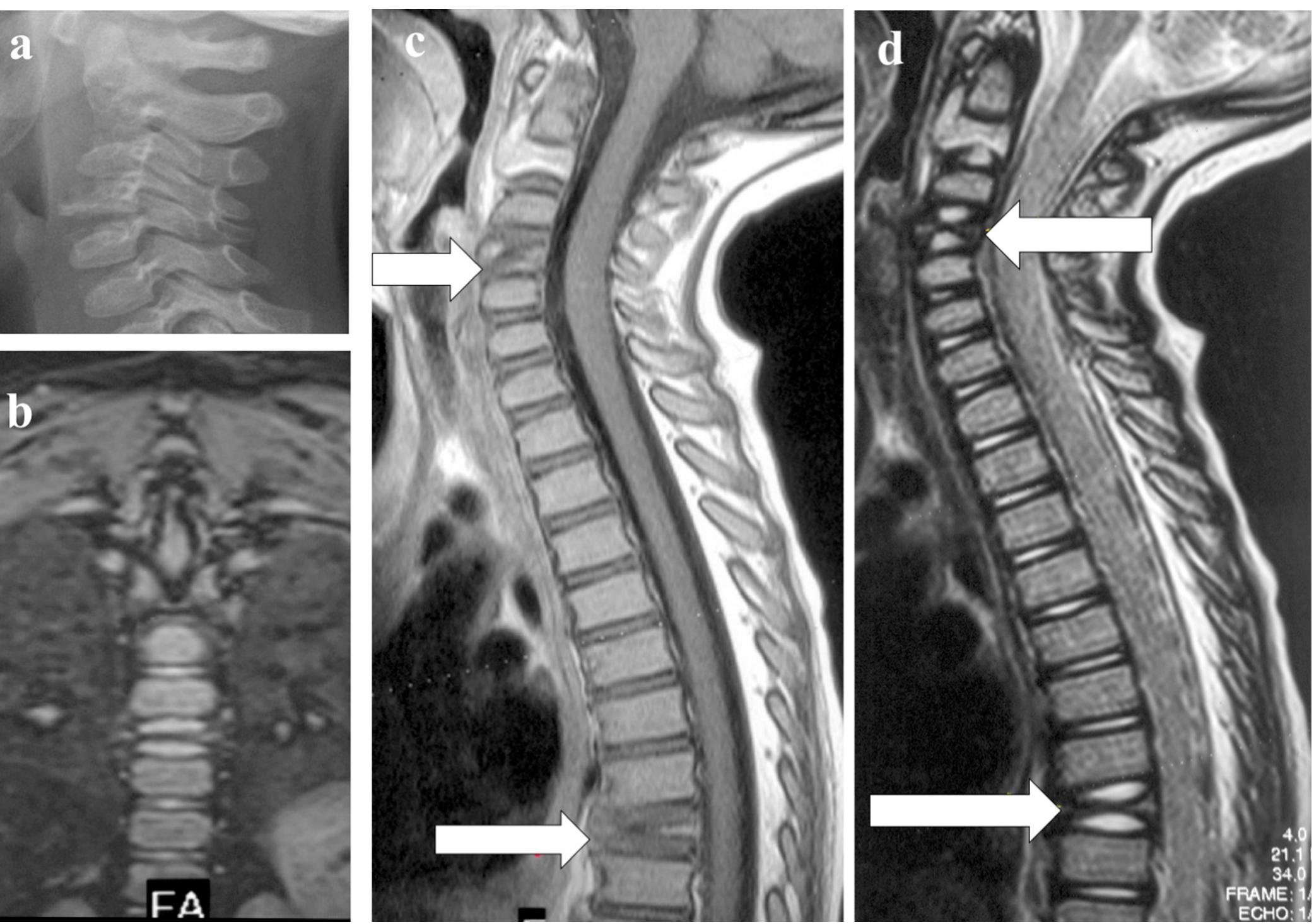 (PDF) Vertebra Plana: A Narrative Clinical and Imaging Overview among ...