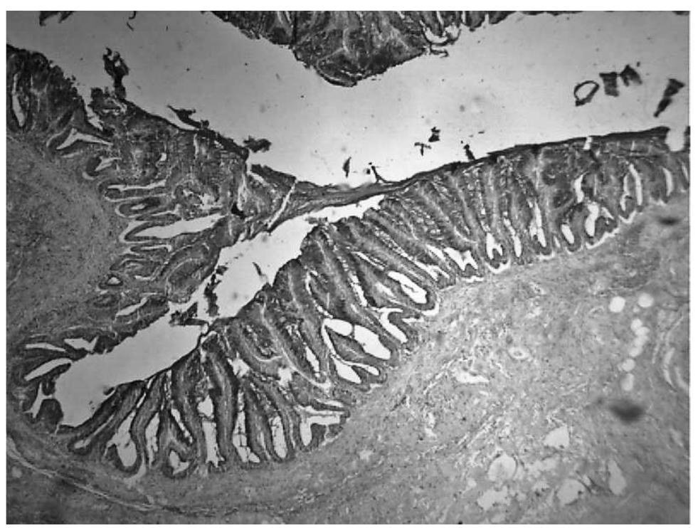 (PDF) Mucocele of the appendix: A case report and review of literature
