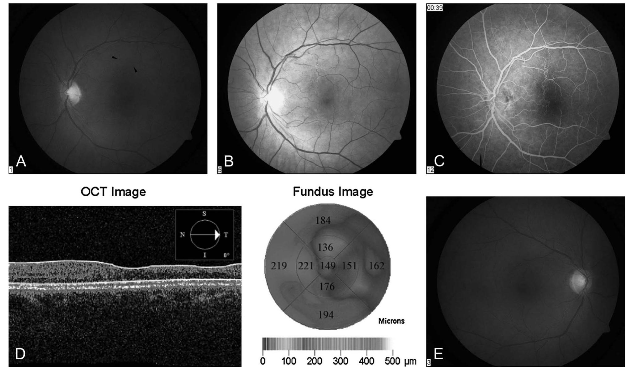 (PDF) Retinal Vascular Occlusions and Macular Thinning in Fibromuscular ...