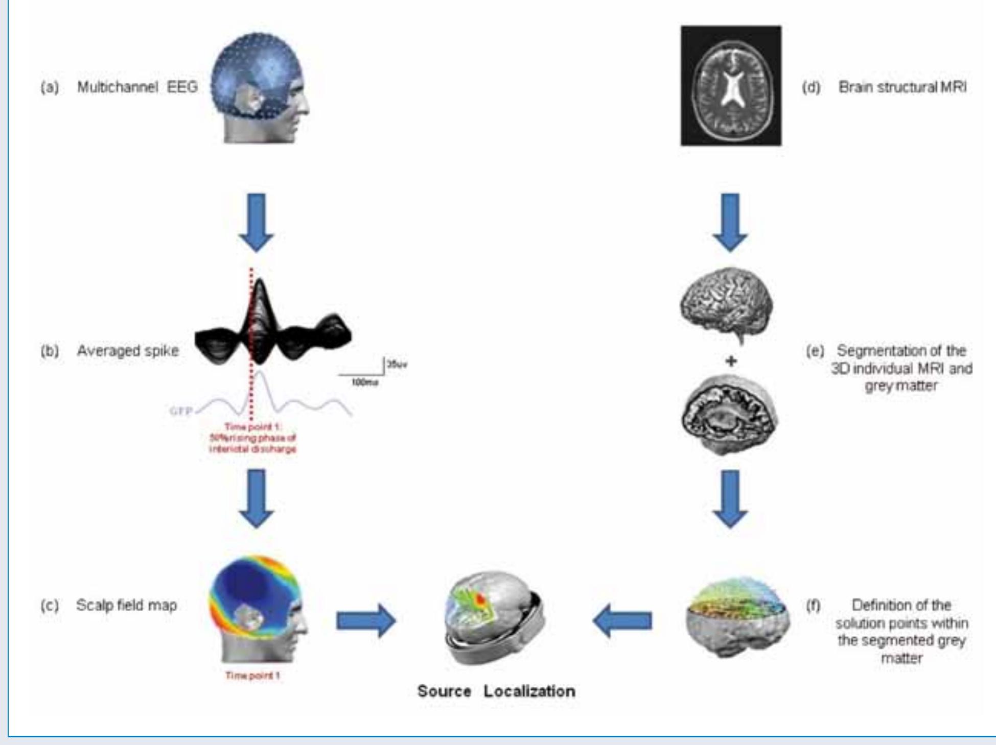 (PDF) A Review on Non-Invasive Localisation of Focal Epileptic