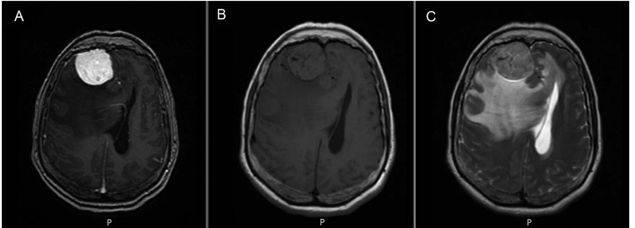 (PDF) Psychiatric Manifestations as the Primary Presentation of Frontal ...