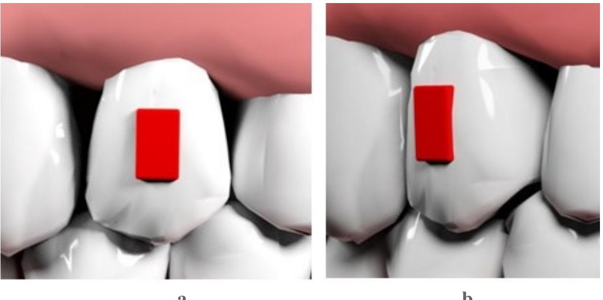 Rectangular Attachment (PDF) Importance of Attachments in Treatment with Clear Aligners: A ...