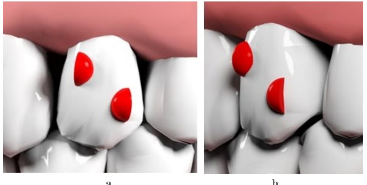 Rectangular Attachment (PDF) Importance of Attachments in Treatment with Clear Aligners: A ...