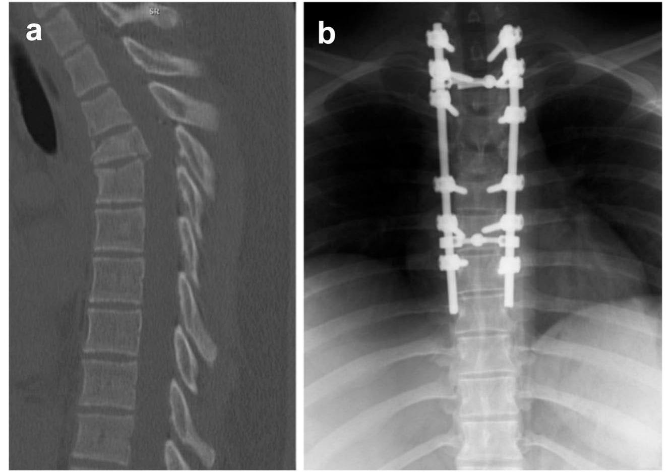 A 17-year-old male presented to the emergency department