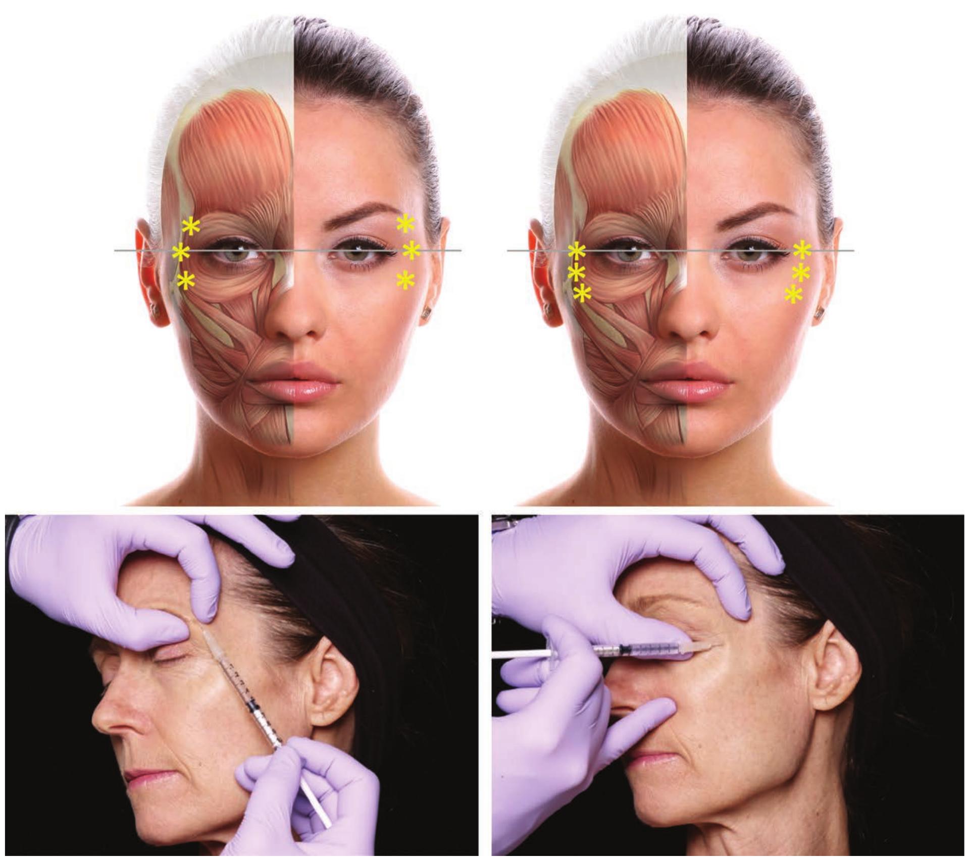 Pat Mac Injection (PDF) Facial Assessment and Injection Guide for Botulinum Toxin and ...