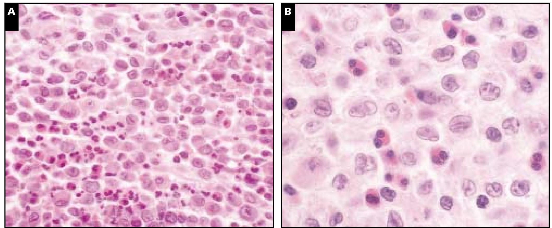 (PDF) Langerhans Cell Histiocytosis