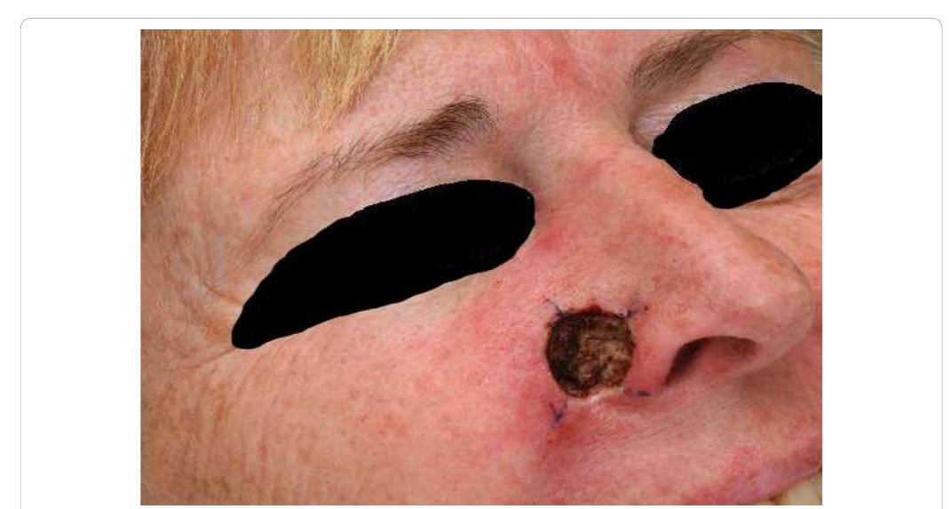 (PDF) How to Reconstruct a Complex Multiunit Skin Defect: A Single-case ...