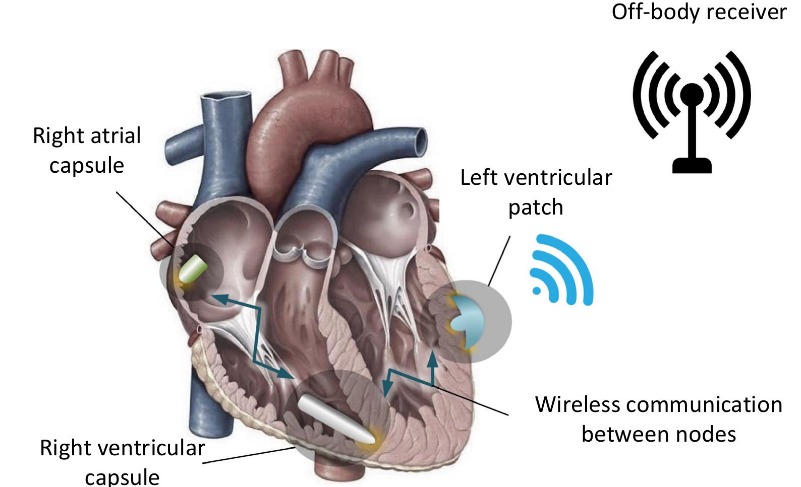 (PDF) Technological and Clinical Challenges in Lead Placement for ...
