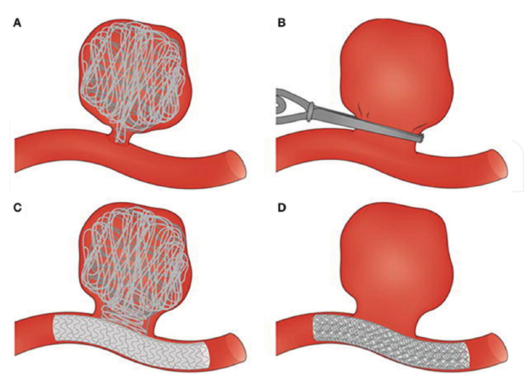 (PDF) Updates in Neuroanesthesia
