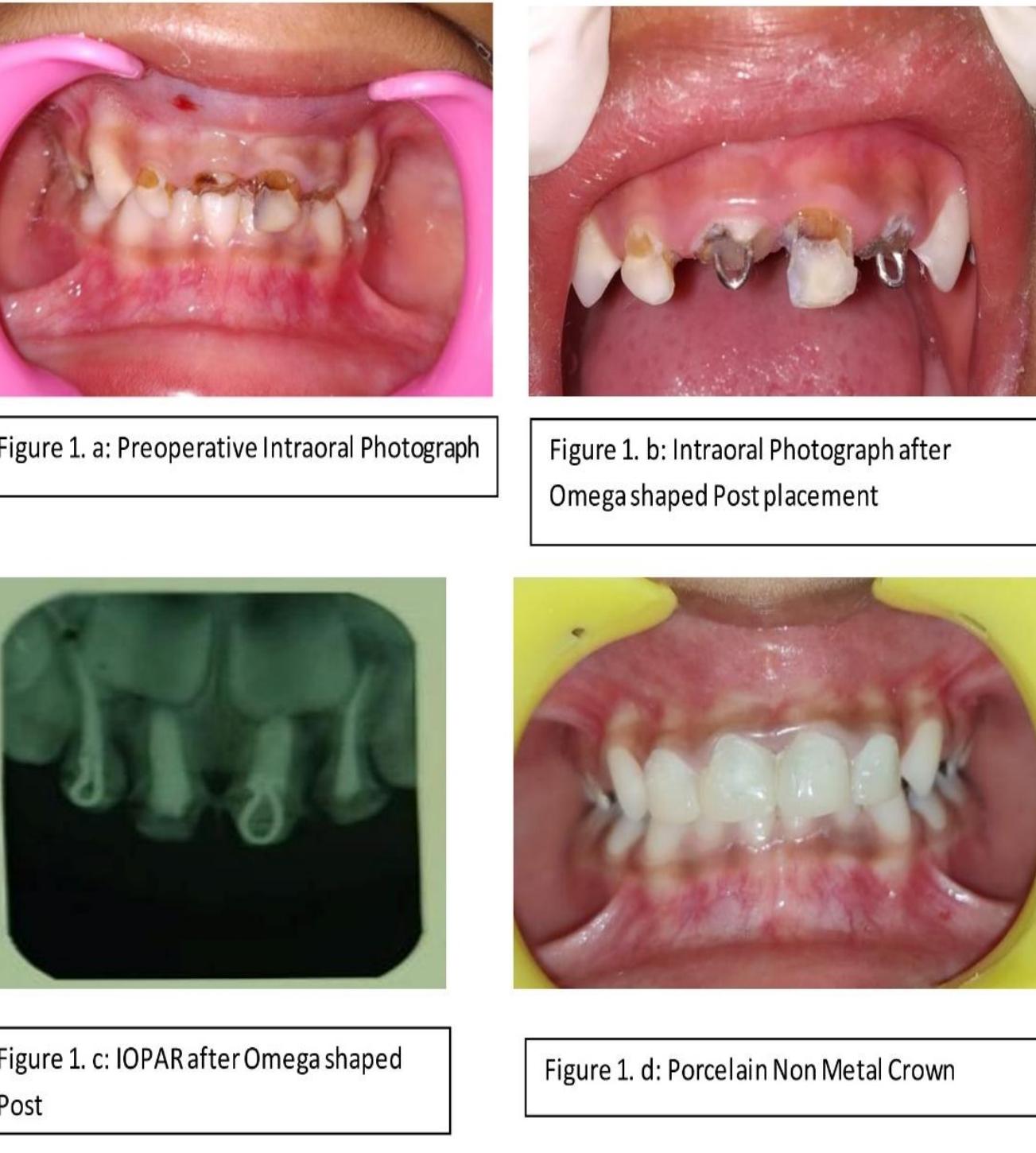 2.2 case report-2 post replacement. prefabricated metal