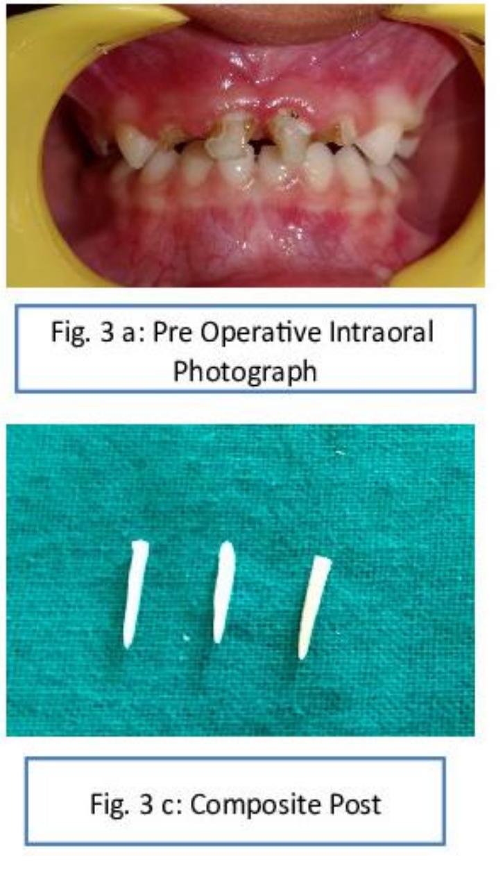 2.2 case report-2 post replacement. prefabricated metal