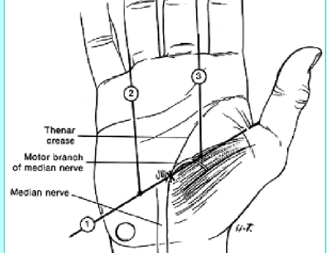 Cardinal Line Hand (PDF) Surgical anatomy of the carpal tunnel