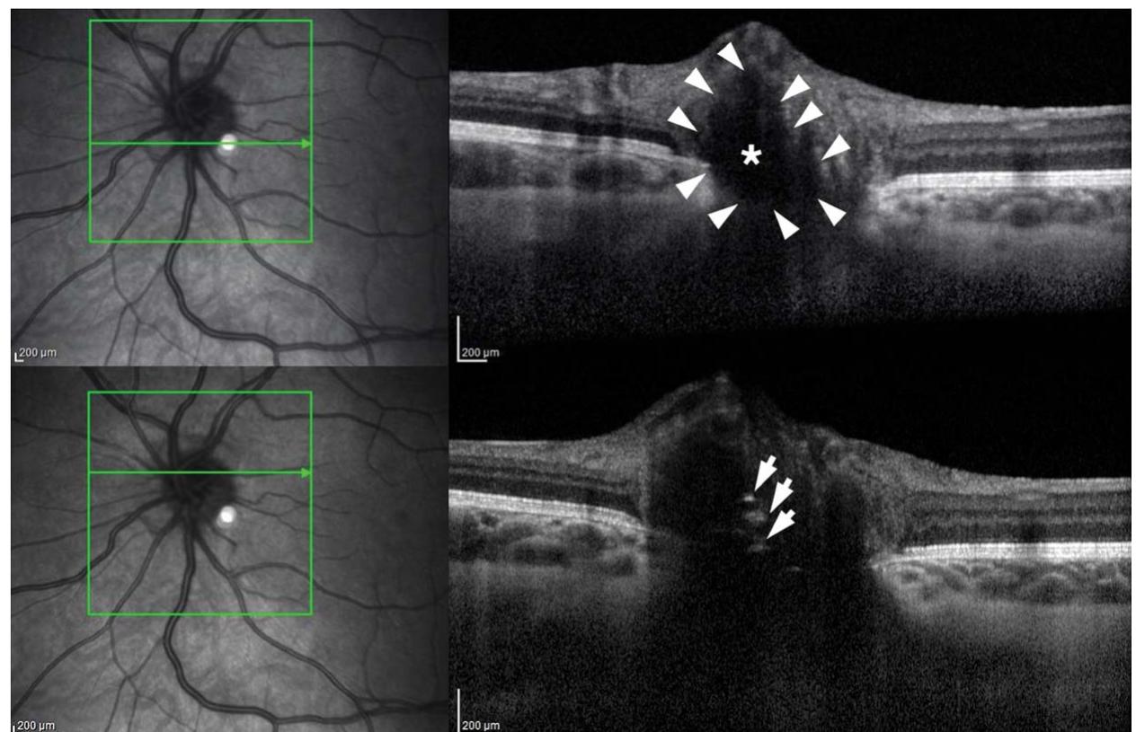 Figure 1 - from Enhanced Depth Imaging Optical Coherence