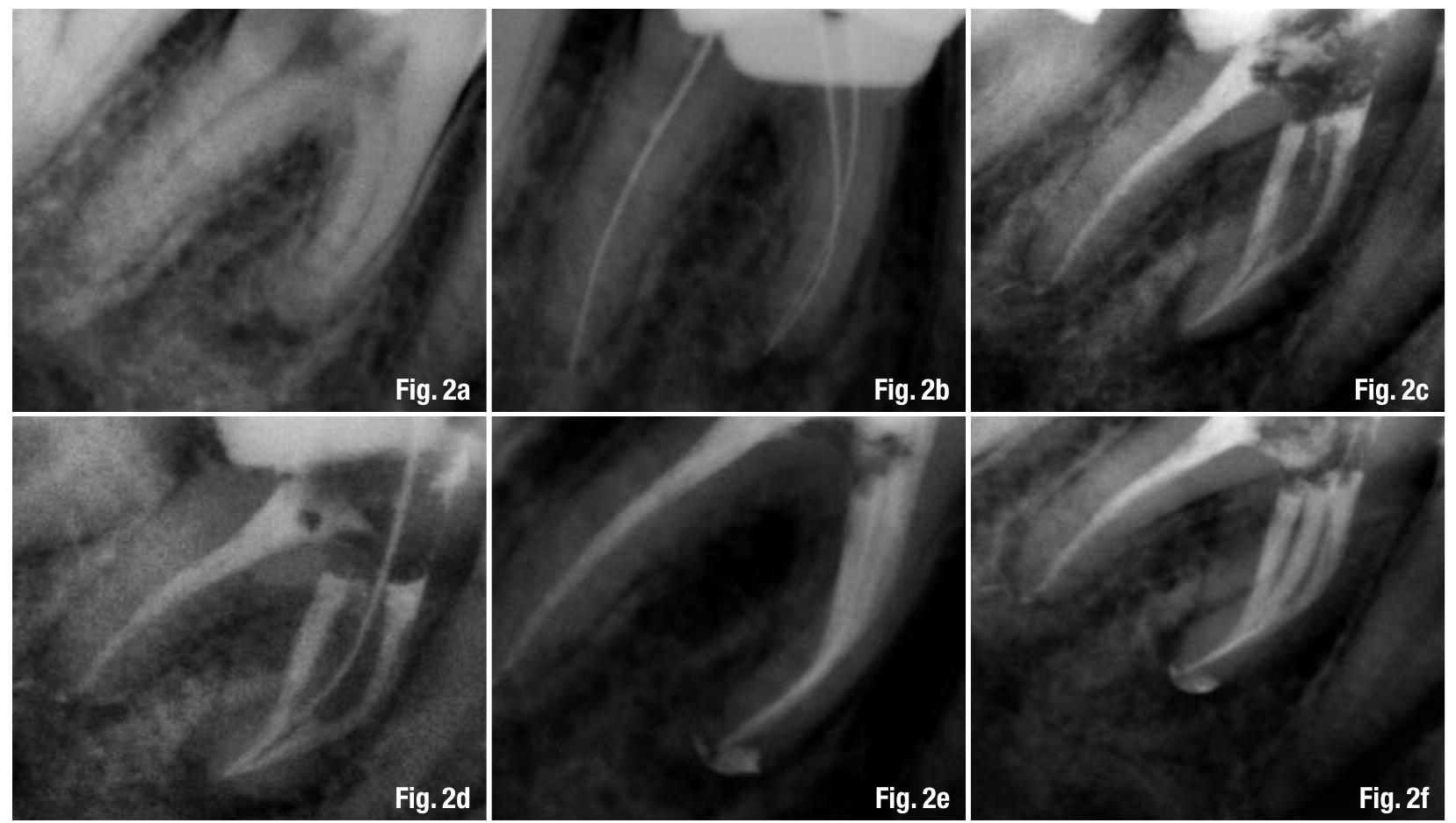 Stout Roots Radiograph (PDF) Root-canal anatomy of the permanent mandibular first molar ...