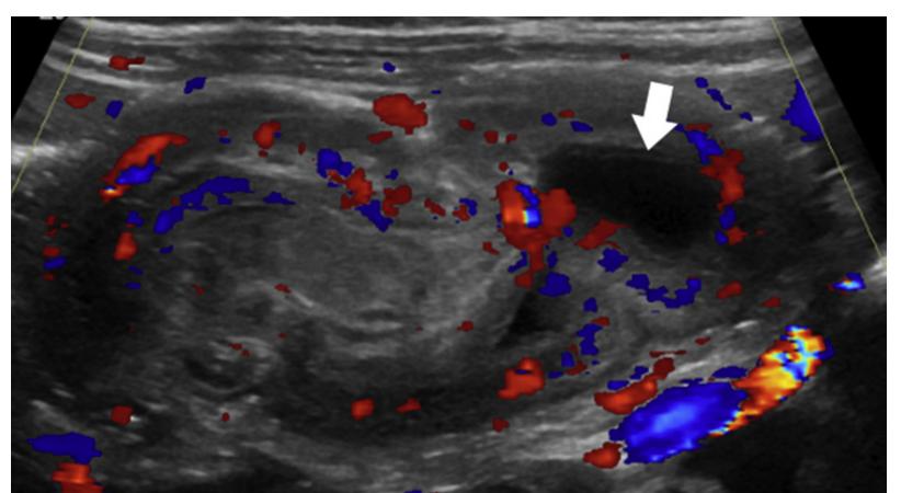 (PDF) Ultrasonography in Pediatric Abdominal Emergencies