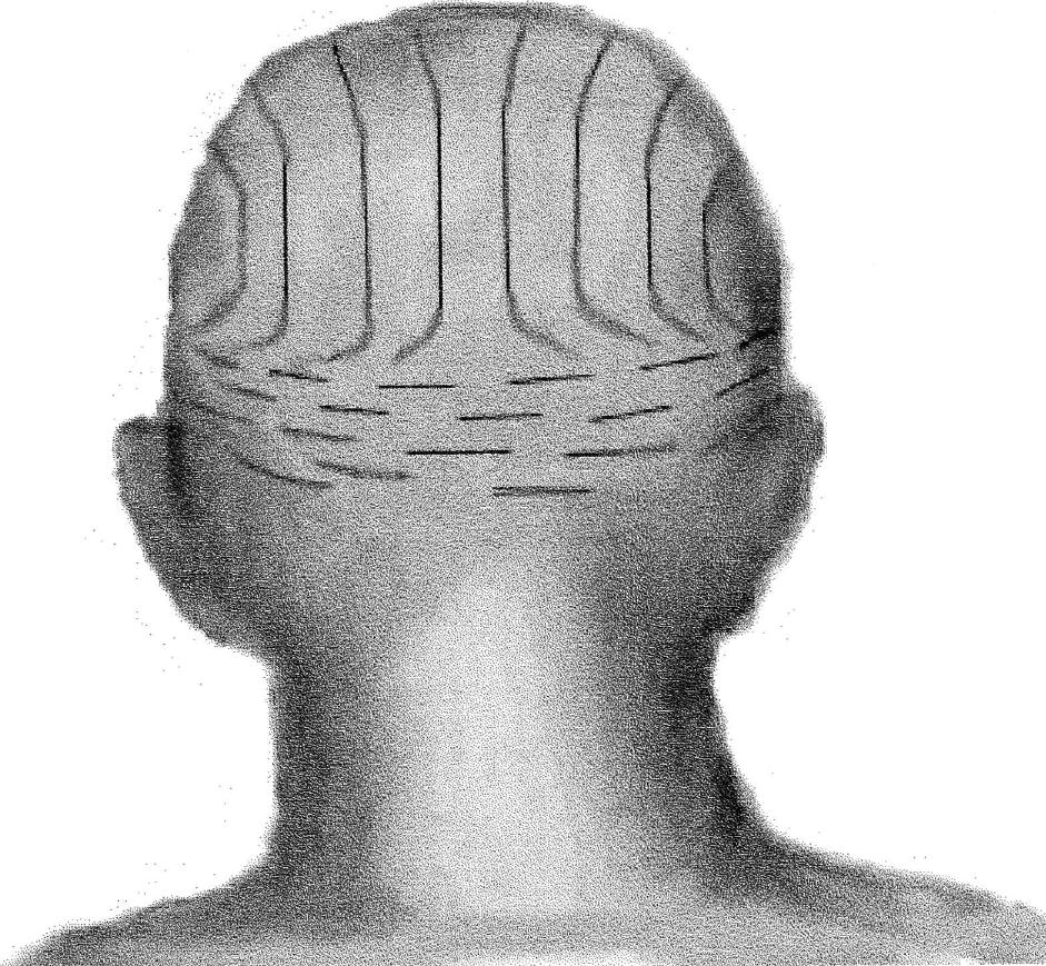 Langer Figure (PDF) The Surgical Anatomy of the Scalp
