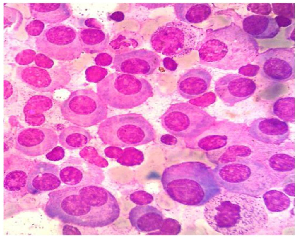 Photomicrograph of bone marrow aspiration showing plasma