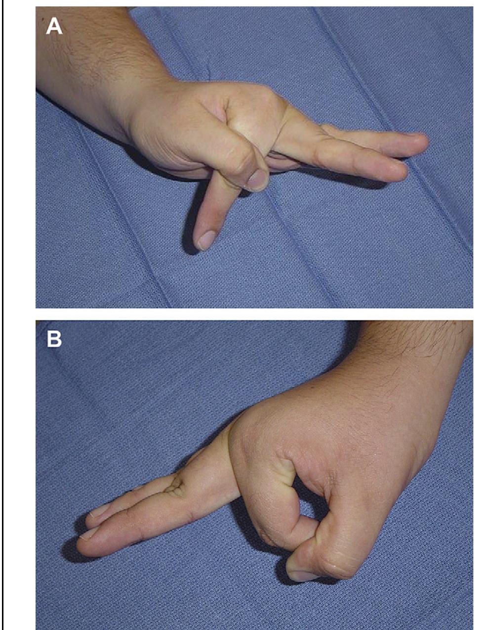 Extensor Contraction (PDF) Technique for Extensor Tendon Acceleration