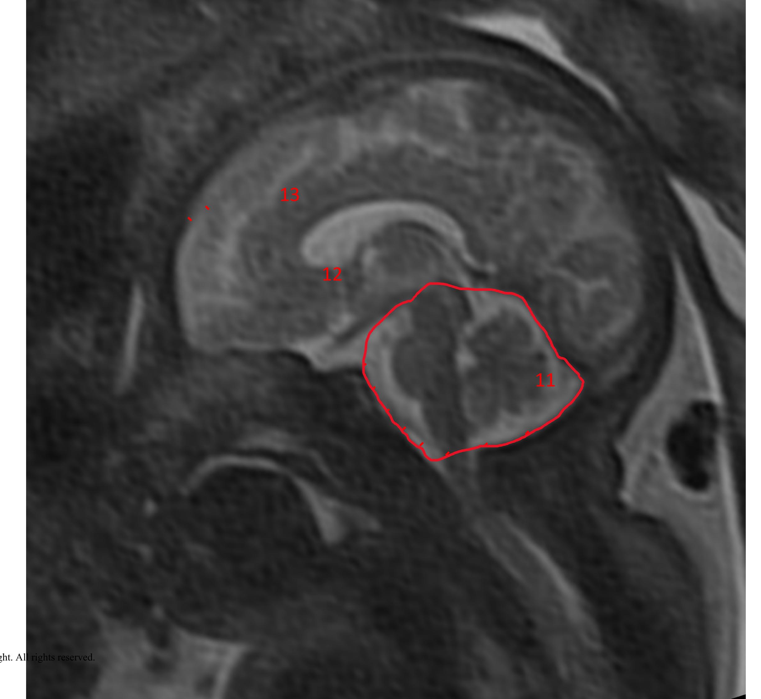 Figure 1 - Biometric assessments of the posterior fossa by