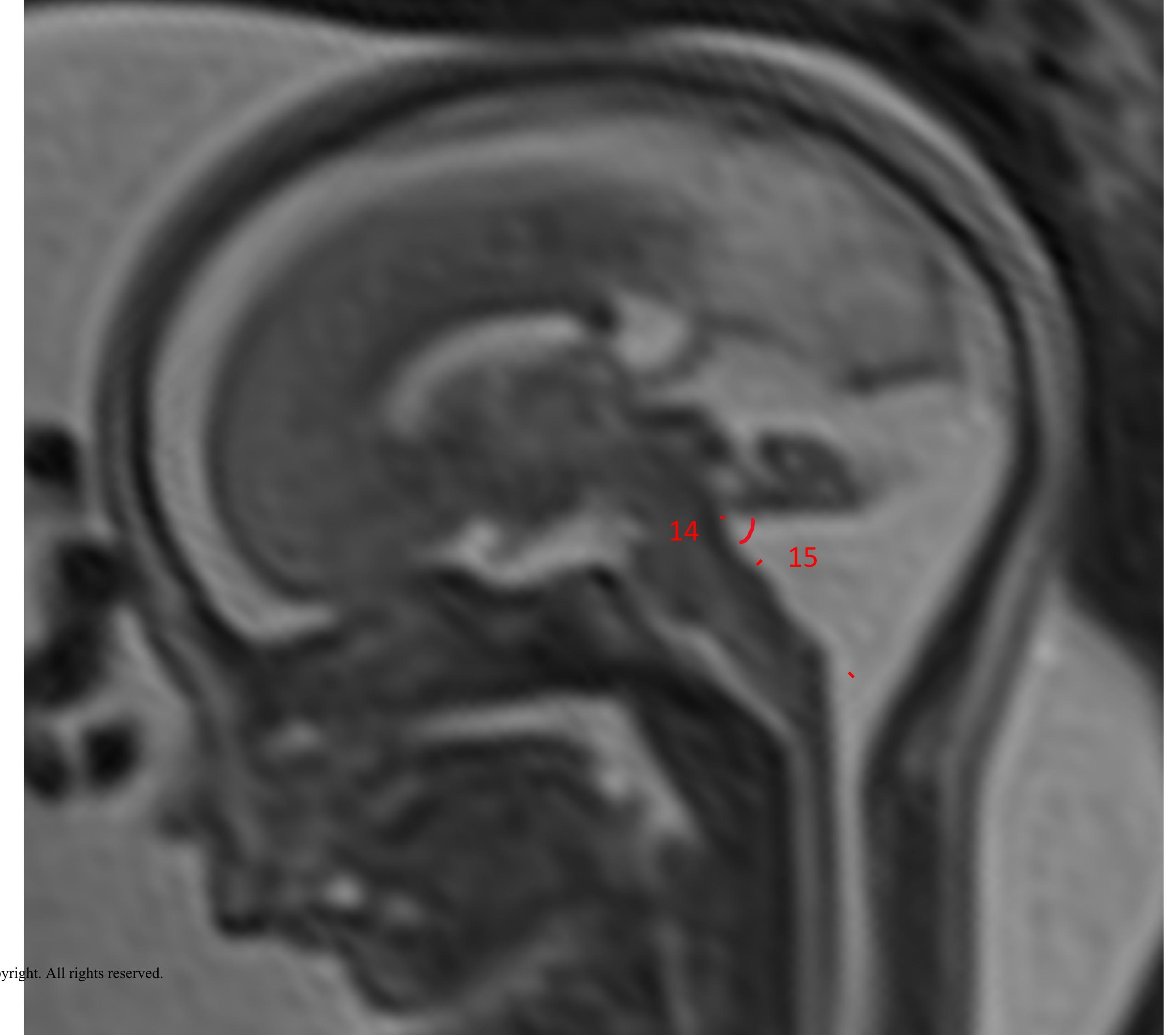 Figure 1 - Biometric assessments of the posterior fossa by