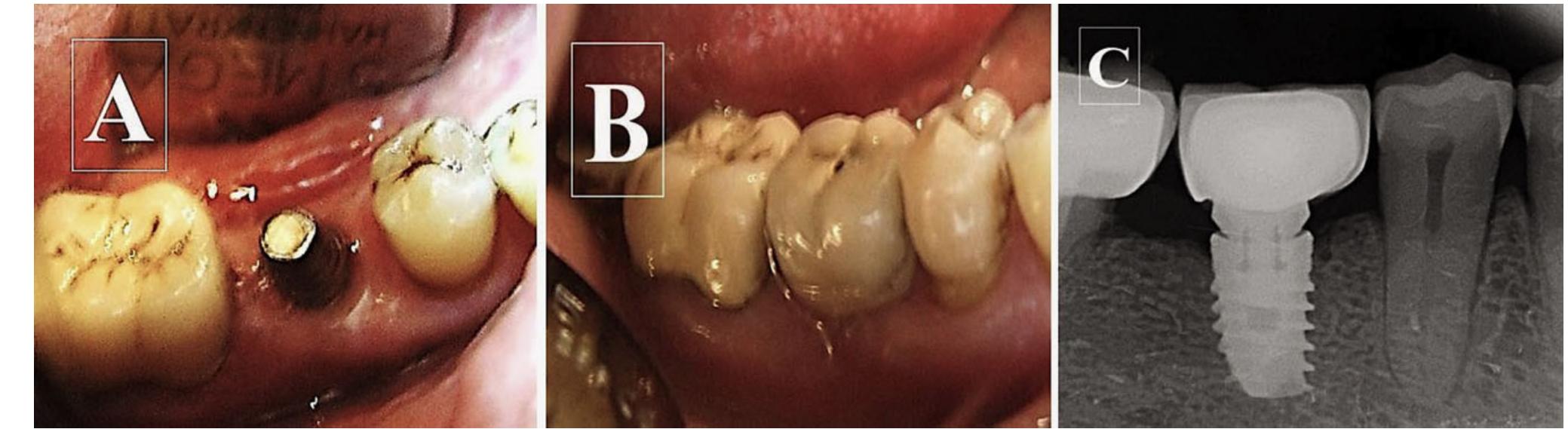 (PDF) Immediate Implant Placement Into Fresh Extraction Sites Using ...