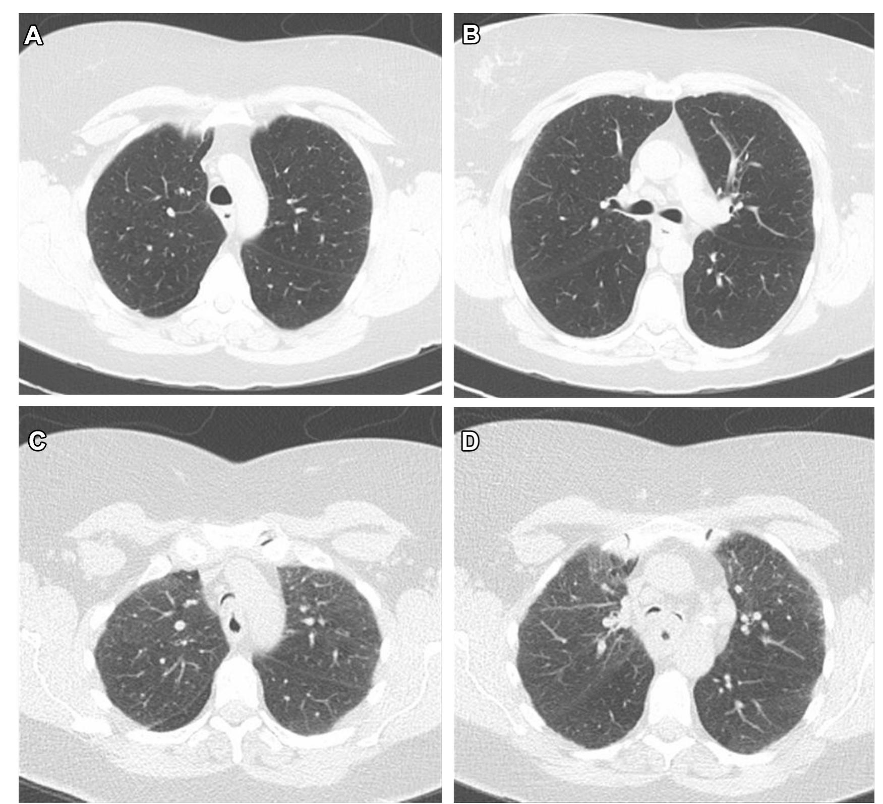 (PDF) Tracheobronchomalacia and Excessive Dynamic Airway Collapse ...