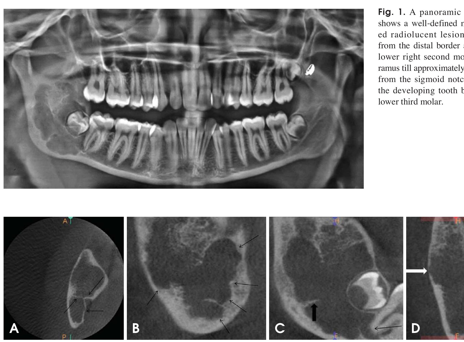 Sharp Ramus (PDF) Glandular odontogenic cyst: A case report