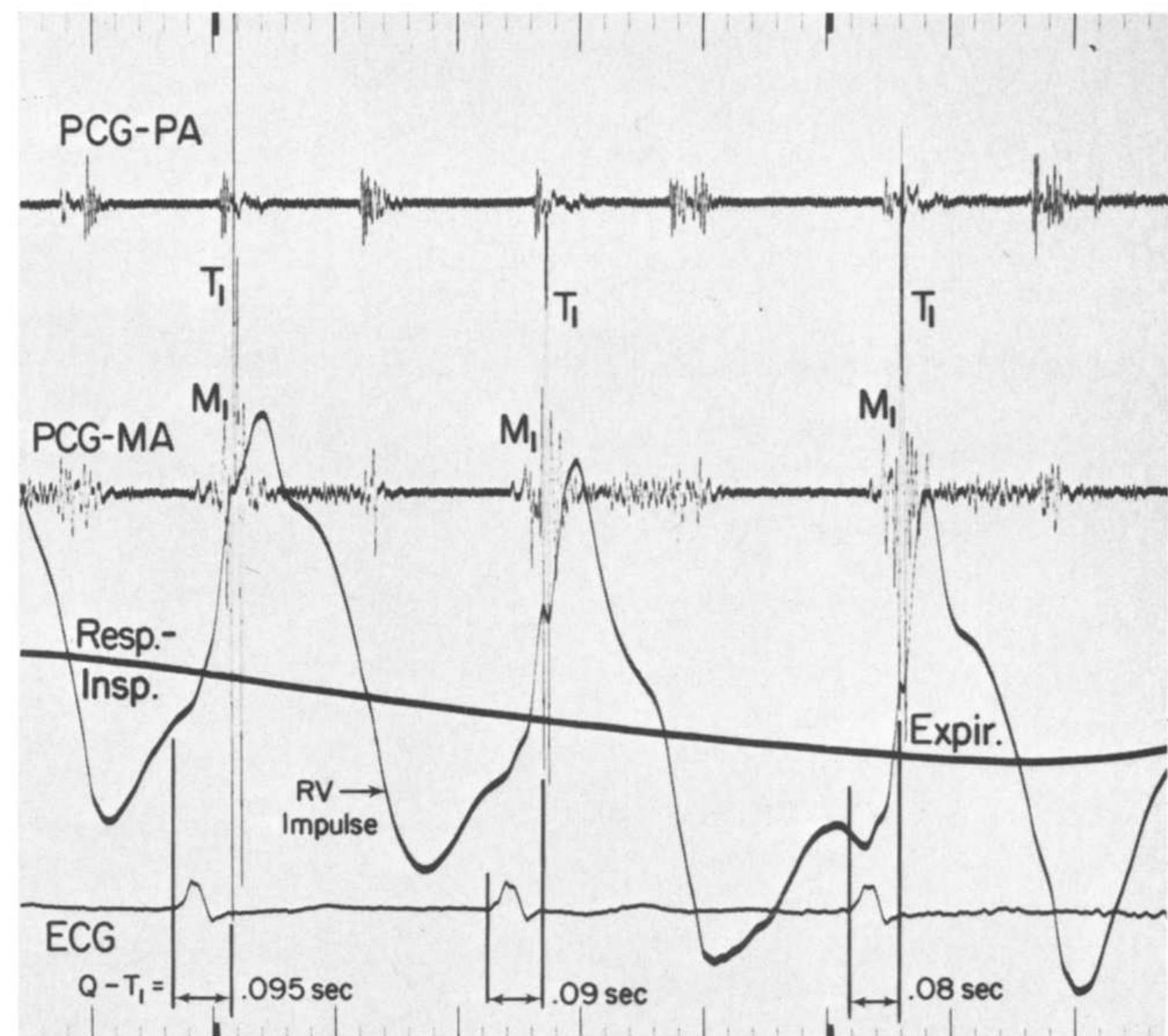 Tricular (PDF) The apex impulse in mitral stenosis: Graphic explanation of the ...