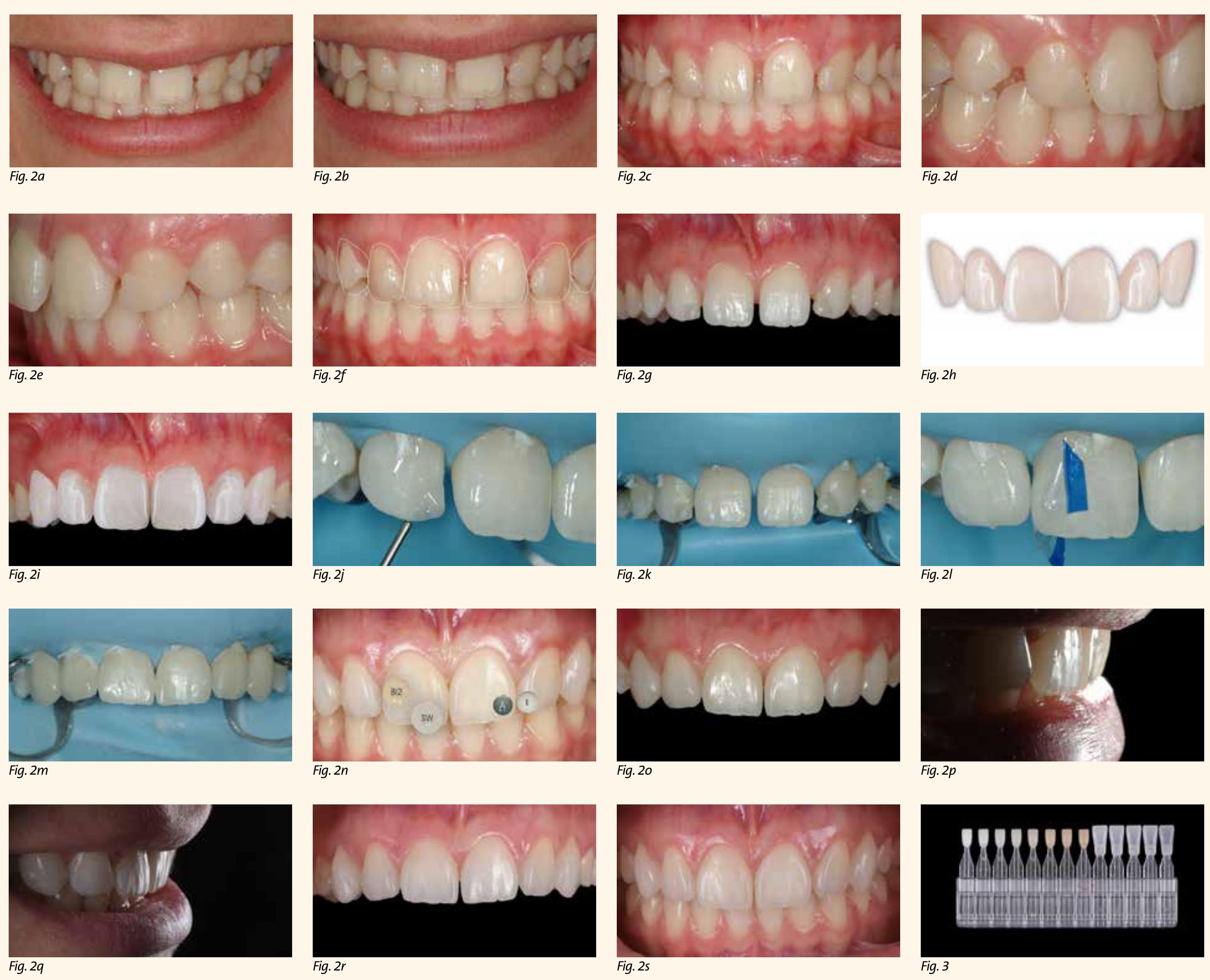 (PDF) Direct bonding in the smile frame: Merging new technologies and ...
