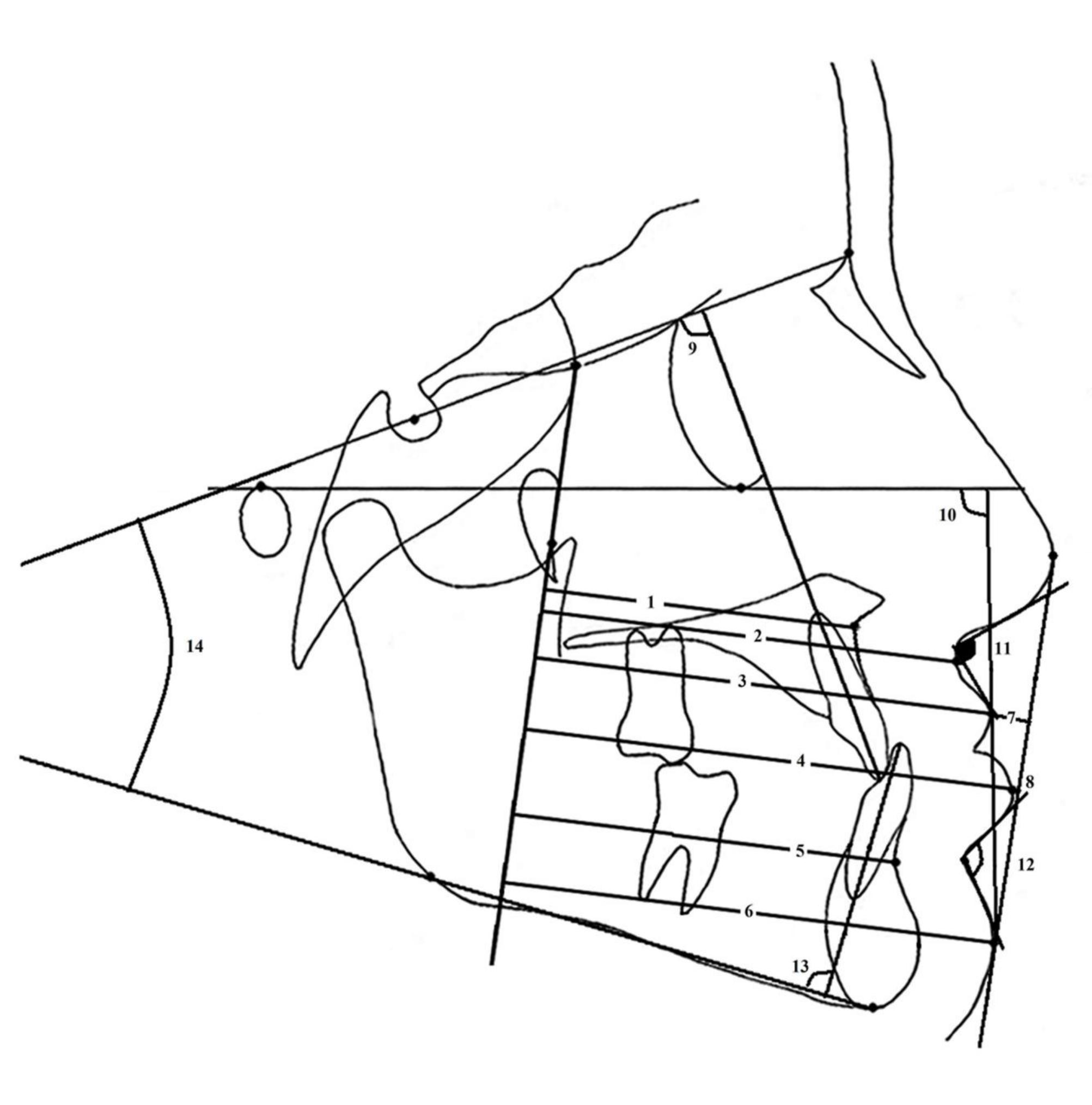 Ricketts Line (PDF) Distinguishing Hard and Soft Tissue Facial Morphology Among Class ...