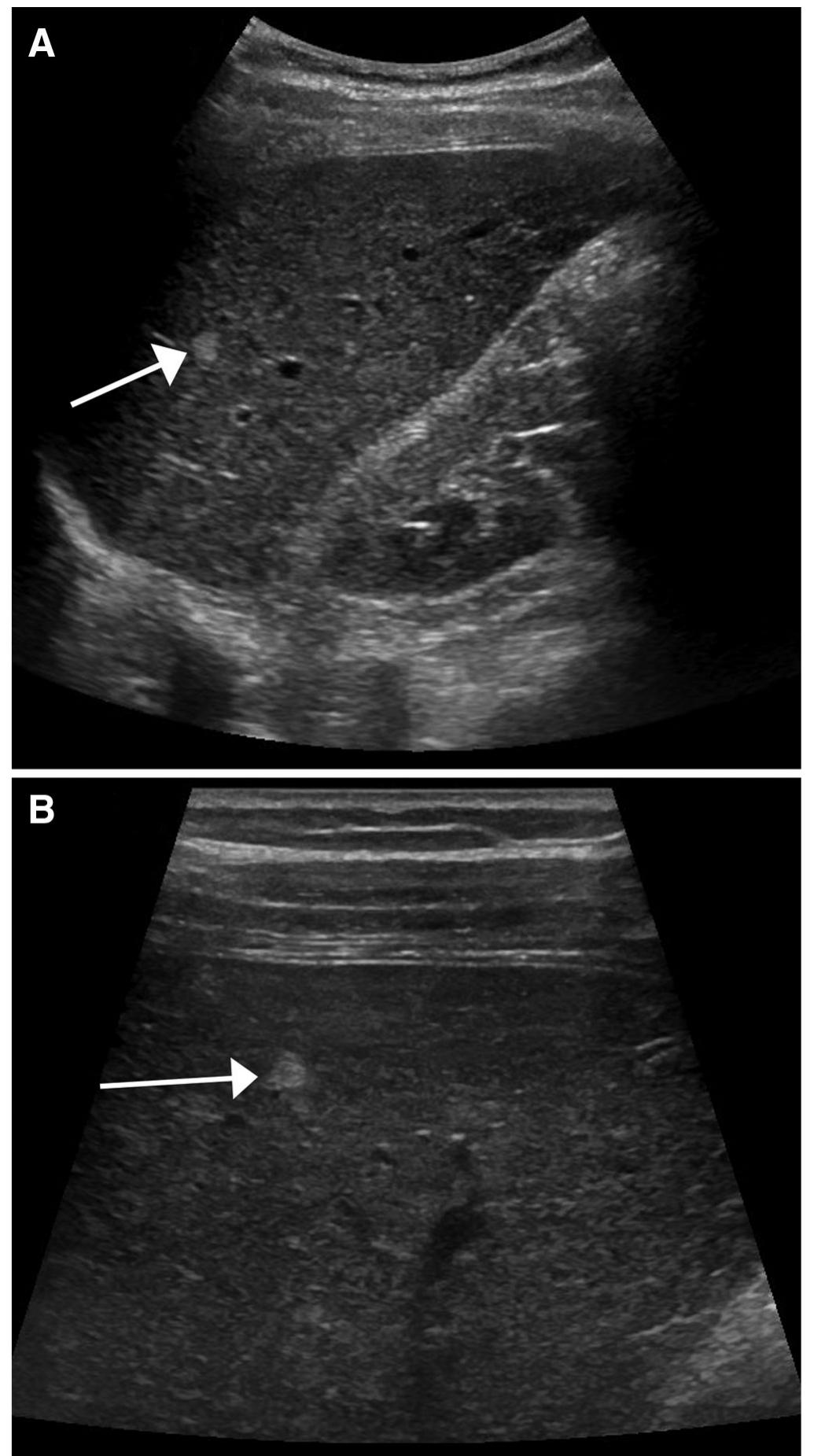 (PDF) US LI-RADS: ultrasound liver imaging reporting and data system ...