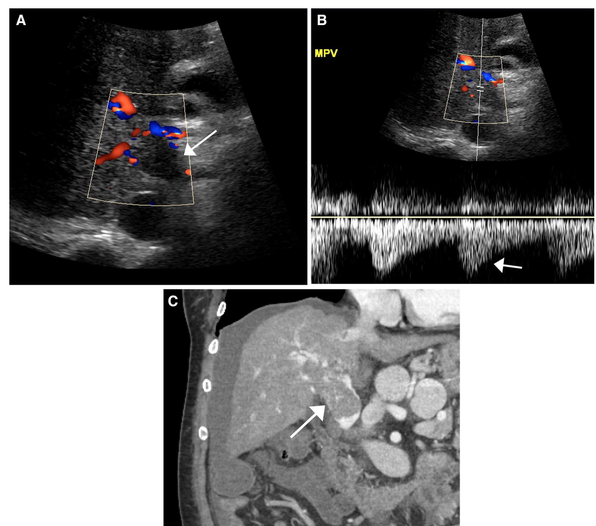 Li Rads Contrast Ultrasound (PDF) US LI-RADS: ultrasound liver imaging reporting and data system ...