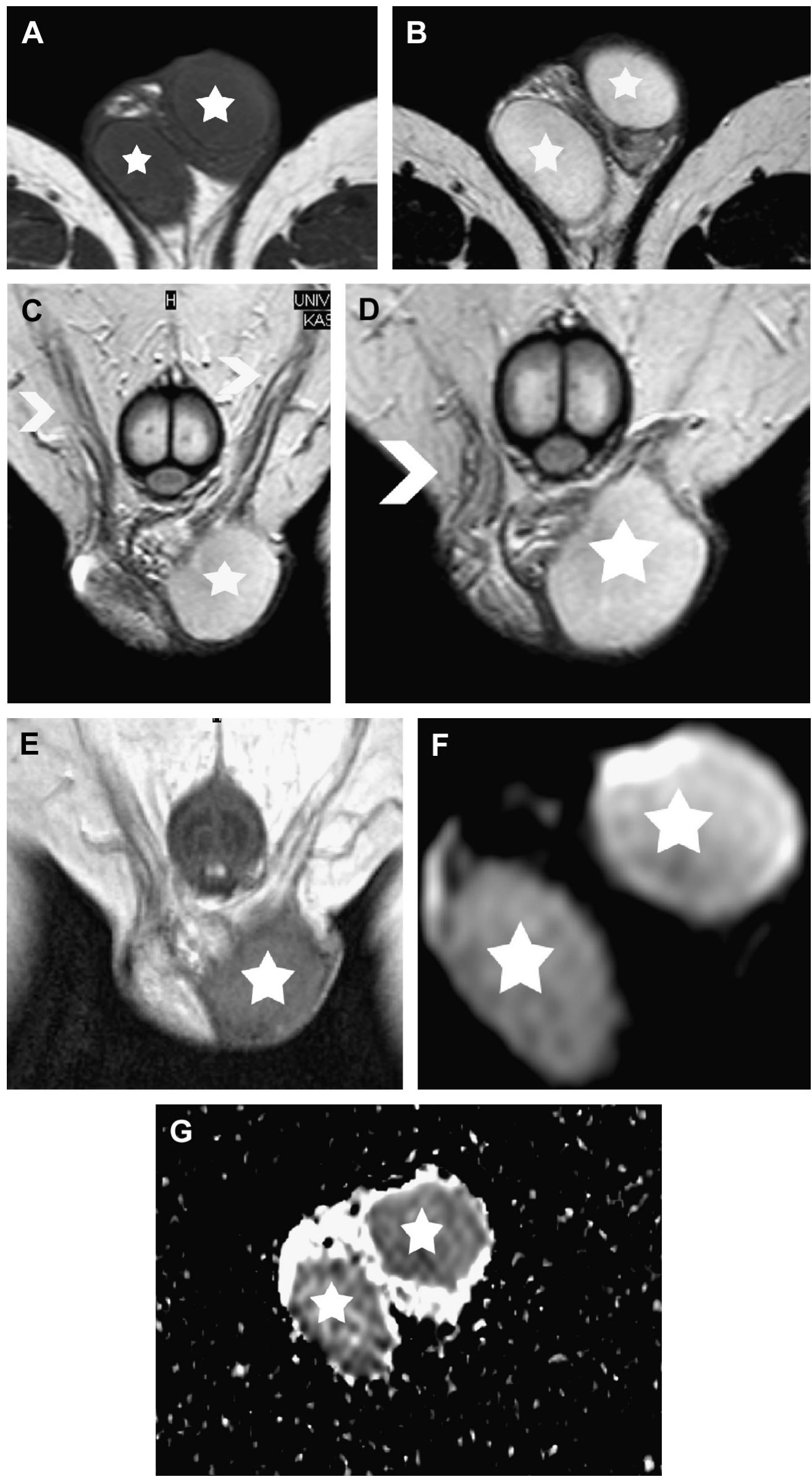 Mri Testes (PDF) MR Imaging of Scrotum
