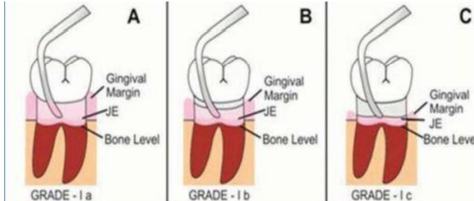 (PDF) Classification of Furcation Involvement - A Literature Review