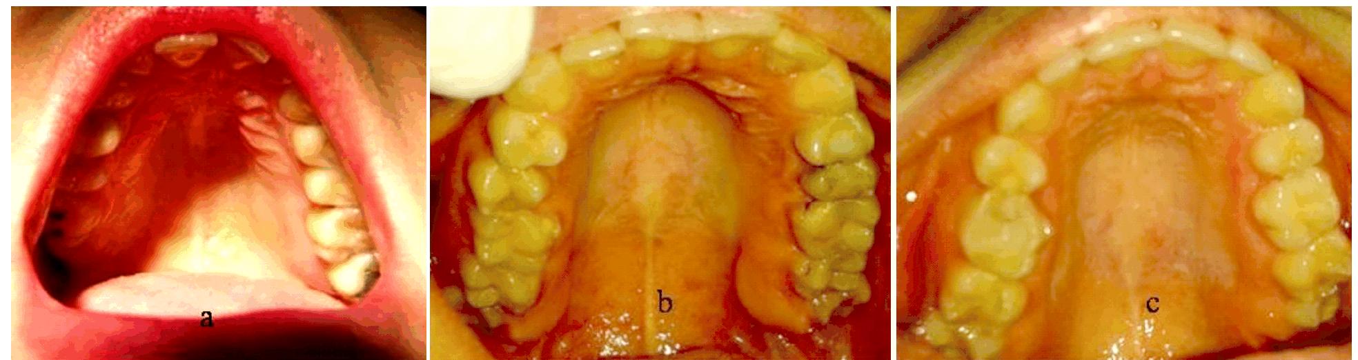 Figure 2 - from The tori of the mouth and ear: A review
