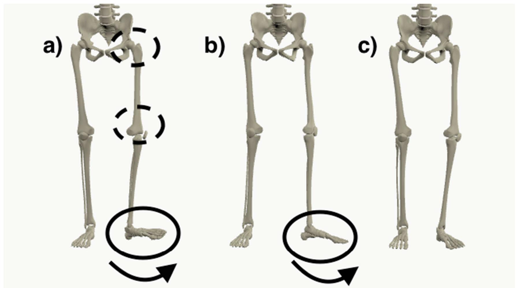 Figure 3 - from Prevalence and unique patterns of lower limb