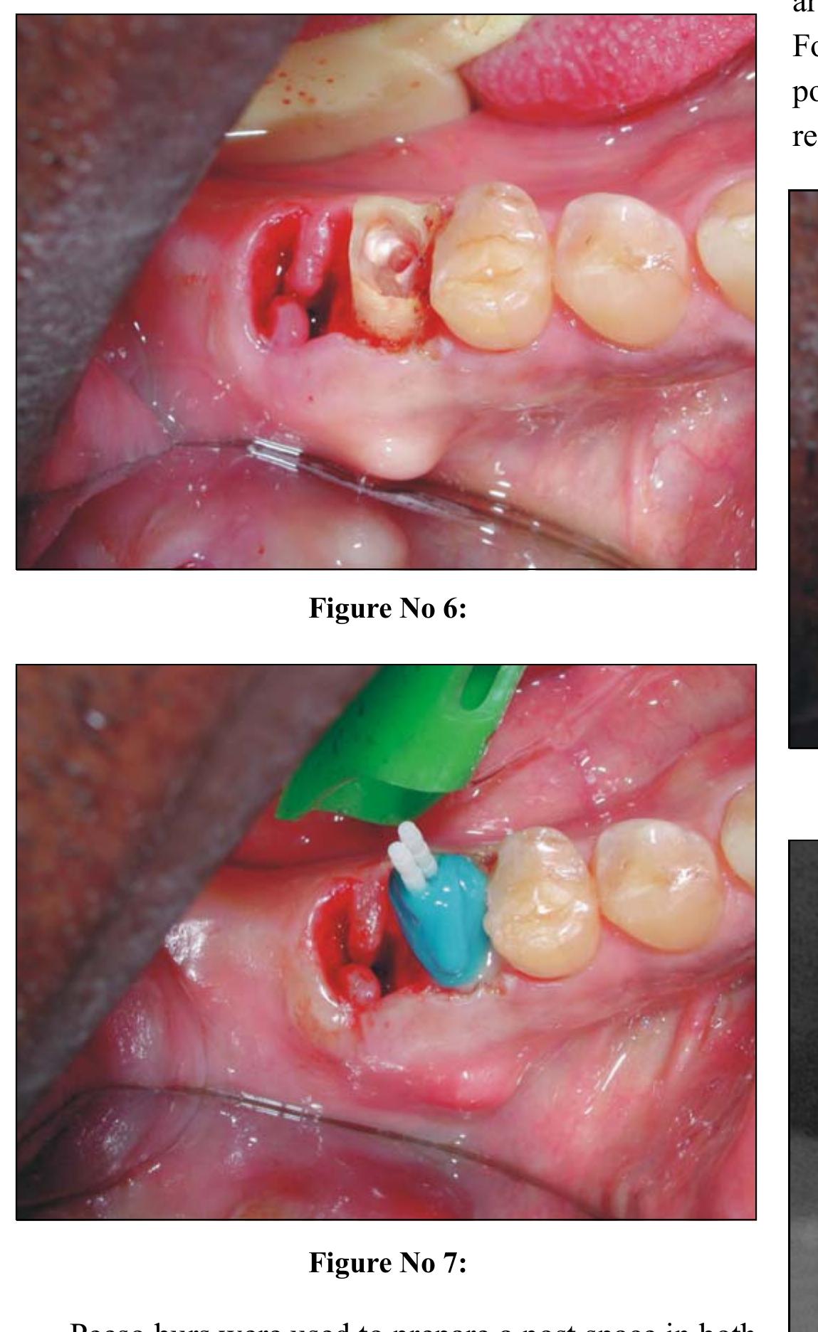 (PDF) Hemisection as an alternative treatment for vertically fractured ...