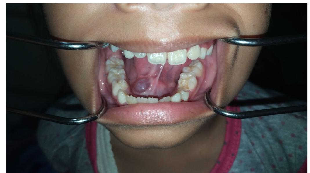 Marsupialization Small Ranula (PDF) Marsupialization as a ranula management: case report