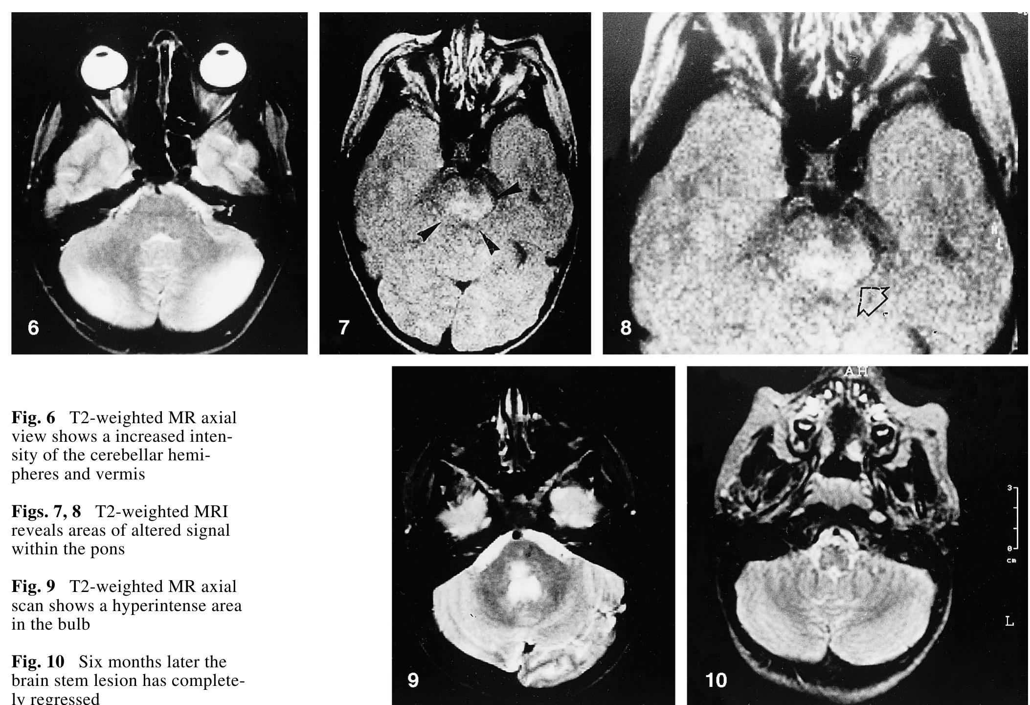 (PDF) Acute cerebellar ataxia in children