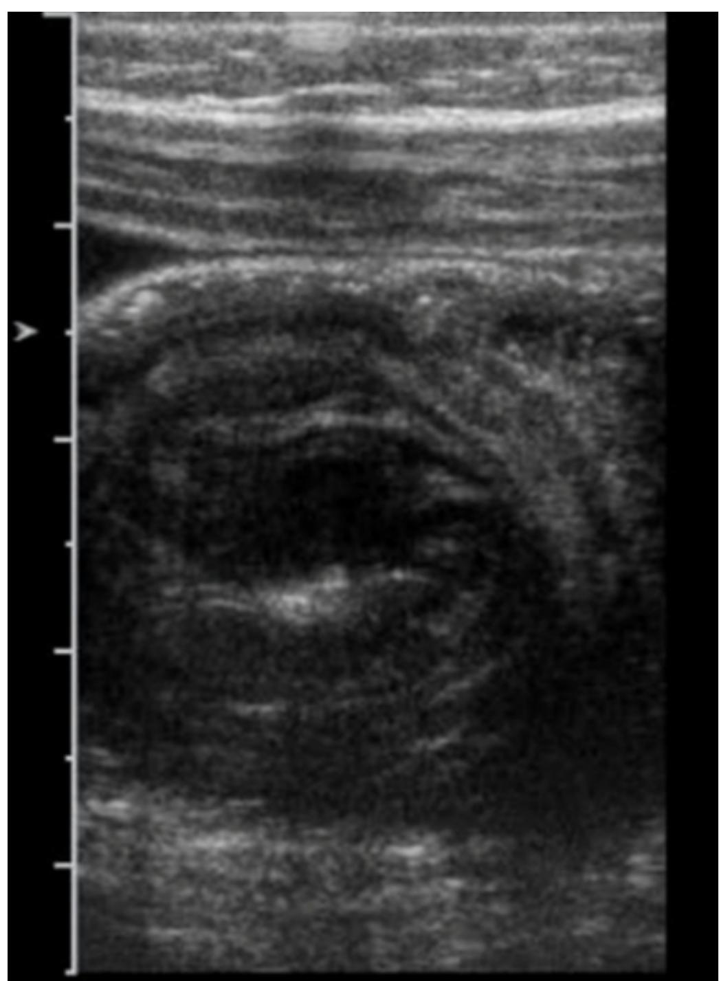 (PDF) Pediatric intussusception: A Case Series and Literature Review