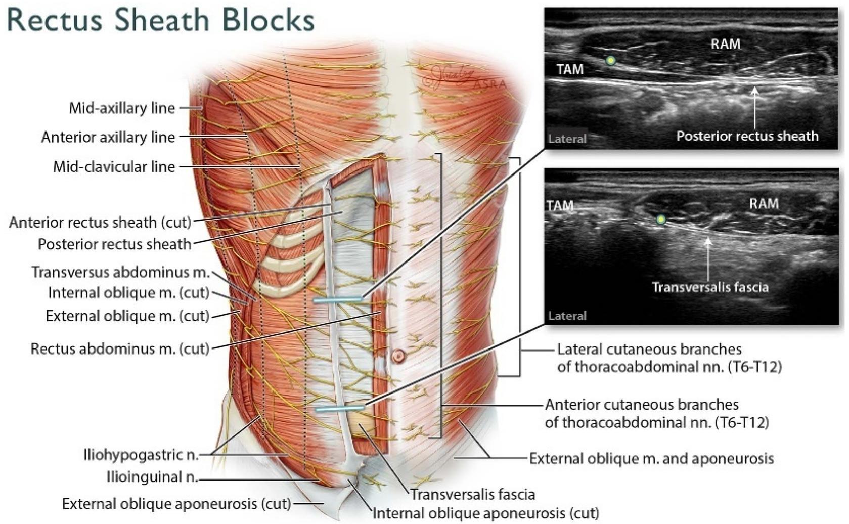 Rectus Sheath Block Target Figure 4 - from Essentials of Our Current Understanding:
