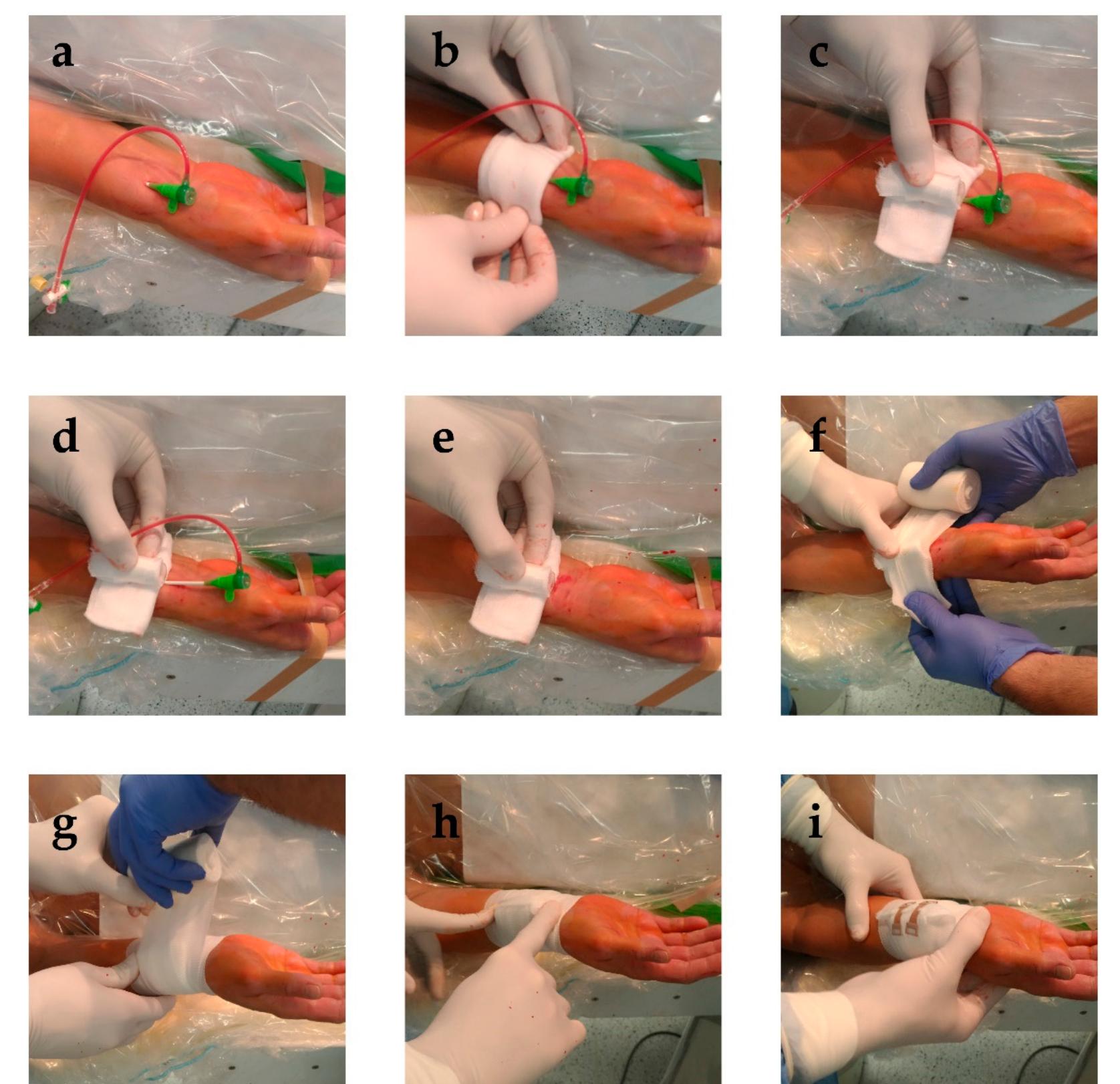 (PDF) Comparison of Safety of RADial comPRESSion Devices: A Multi ...