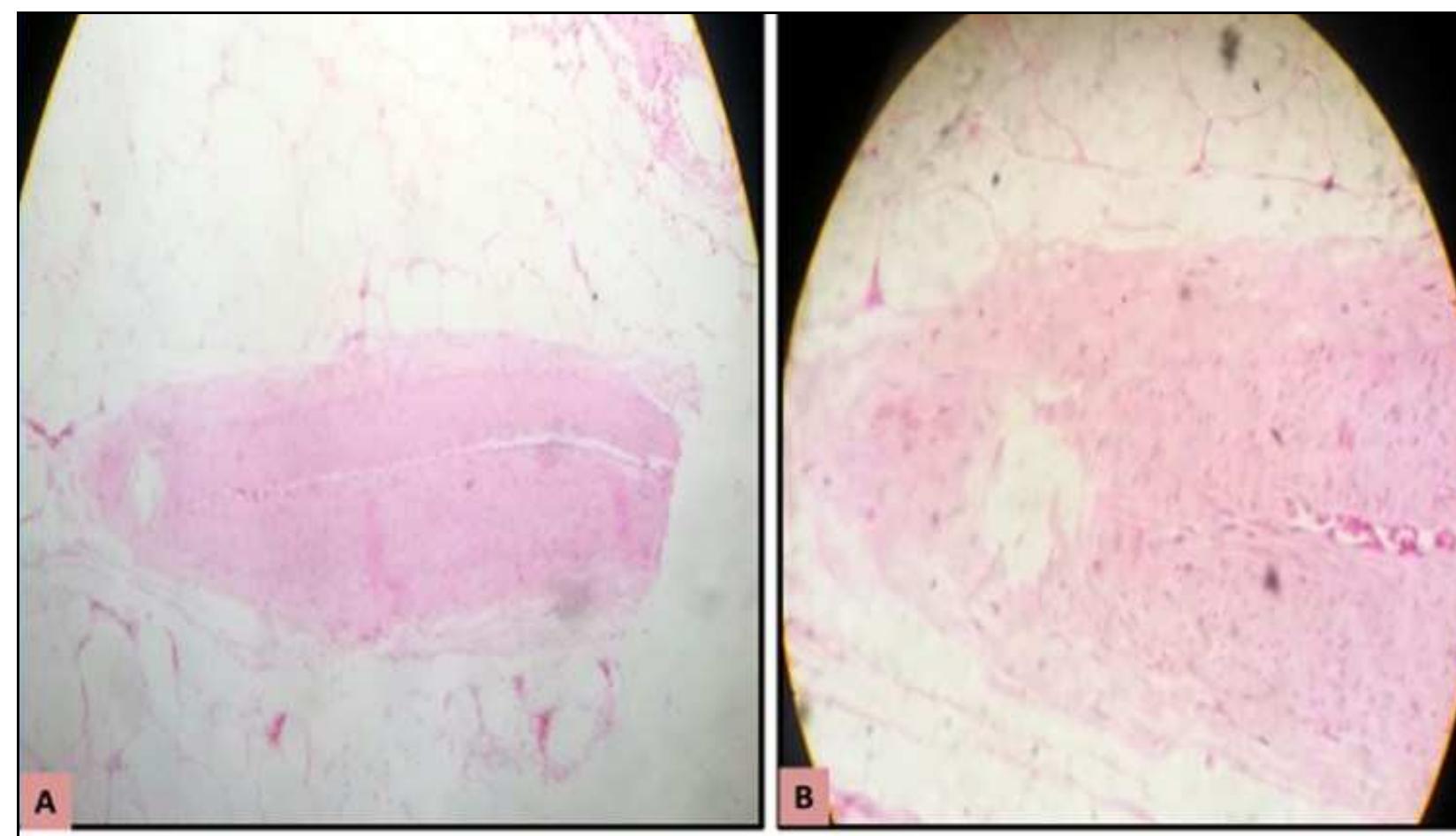 Figure 2 - from Appendiceal Hypoplasia - An Extremely Rare