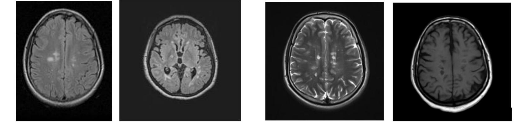 The various stages of the multiple sclerosis francesco,